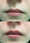 Photos show patient before (above) and after (below) procedure 