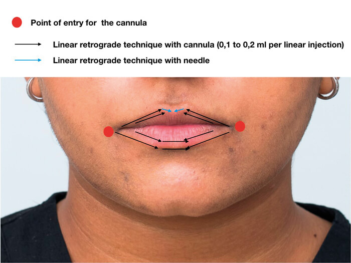 HOW I DO IT Lip augmentation a multiproduct approach The PMFA Journal