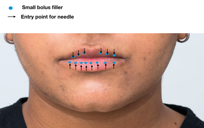 Photo showing areas of lip