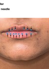 Photo showing areas of lip