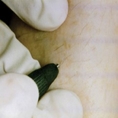 Hair removal: a summary of techniques with a particular emphasis on the importance and versatility of electrolysis | The PMFA Journal Hair removal: a summary of techniques with a particular emphasis on the importance and versatility of electrolysis | The PMFA Journal