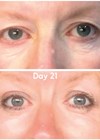 Patient photographs before and 21 days after non-surgical blepharoplasty using Plasma Elite