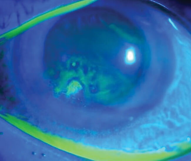 Photo showing fluorescein staining showing abnormal uptake suggestive of recurrent corneal erosion. 