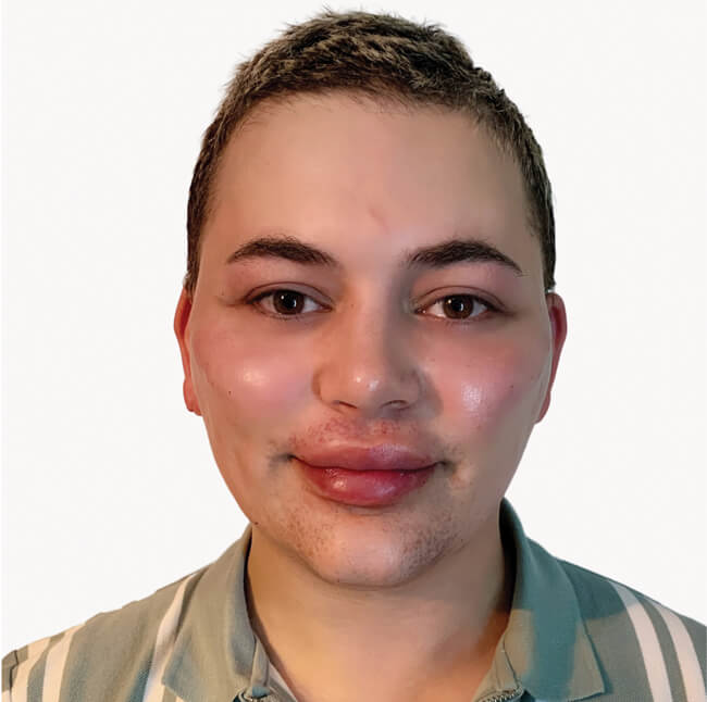 Photo showing lips are fuller, more feminine and symmetrical. 