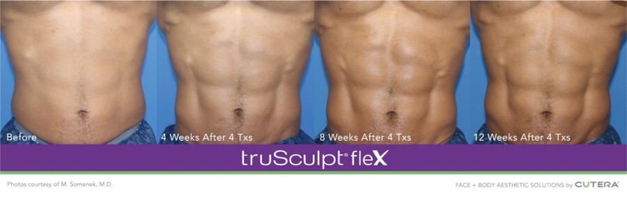 Photo showing typical results achieved over four sessions, 12 weeks post treatment, in Sculpt mode.
