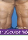 Photo showing typical results achieved over four sessions, 12 weeks post treatment, in Sculpt mode.