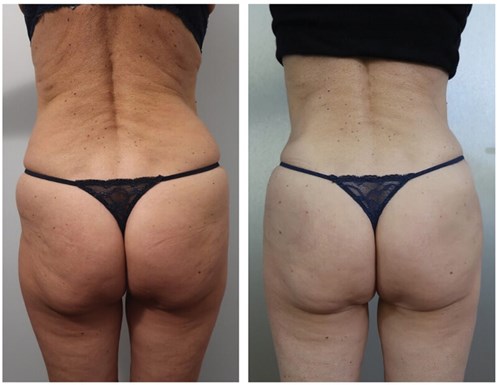 HOW I DO IT - Buttock augmentation with hyaluronic acid fillers