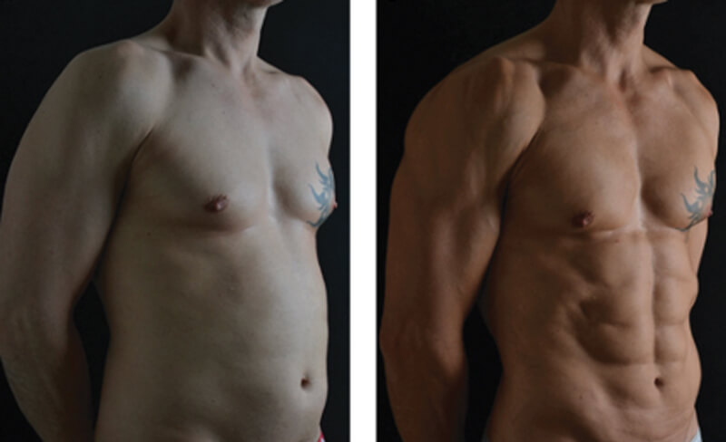 Photo showing (Left) A 35-year-old make after PAL-HD liposculpture of the chest, abdomen, back and arms, along with fat transfer to the chest for pectoral definition. There are six abdominal packs.  (Right) At six months postoperatively there is visual harmony between the different body parts.