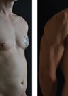 Photo showing (Left) A 35-year-old make after PAL-HD liposculpture of the chest, abdomen, back and arms, along with fat transfer to the chest for pectoral definition. There are six abdominal packs.  (Right) At six months postoperatively there is visual harmony between the different body parts.
