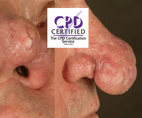 Rhinophyma article photo with CPD stamp.