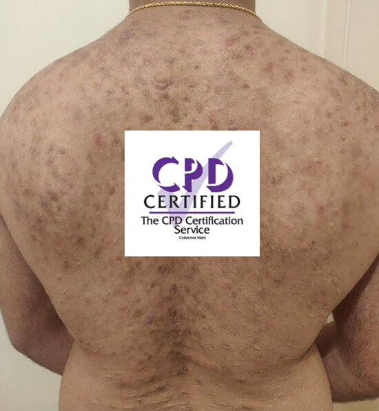 Hyperpigmentation case photo with CPD logo.