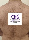 Hyperpigmentation case photo with CPD logo.
