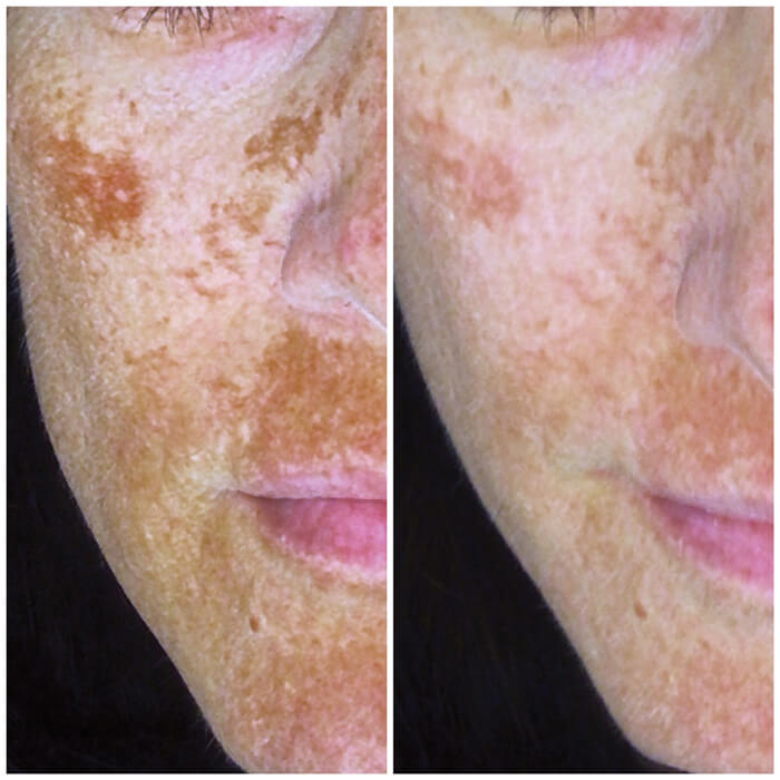 Treatment of pigmentation and melasma article photos