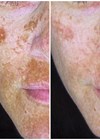 Treatment of pigmentation and melasma article photos 