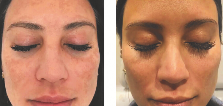 Photo showing patient with melasma – before and after treatment with four sessions with Aerolase and one light peel  