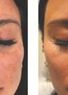Photo showing patient with melasma – before and after treatment with four sessions with Aerolase and one light peel