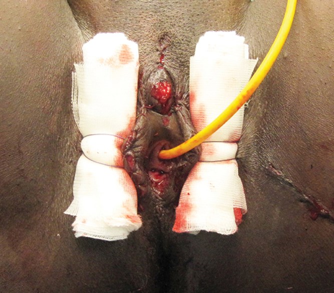 From female genital mutilation to female genital reconstruction | The