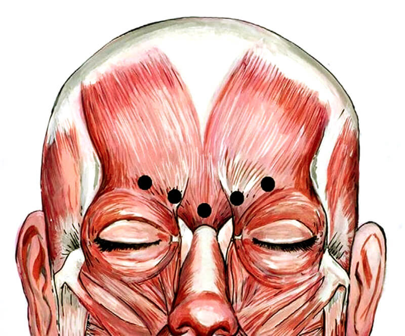 Image showing typical injection sites in corrugator muscle for glabellar lines.