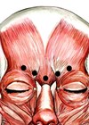 Image showing typical injection sites in corrugator muscle for glabellar lines. 