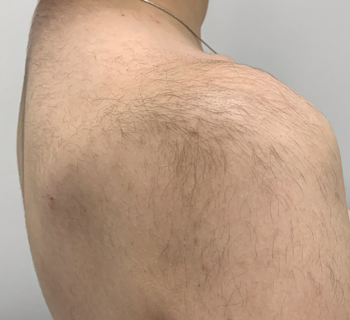 Clinical case of hypertrichosis article image.