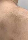 Clinical case of hypertrichosis article image.