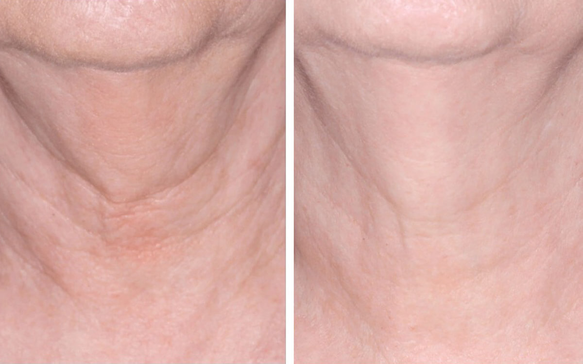 Photo showing pre and post treatment with Nectifirm®.