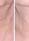 Photo showing pre and post treatment with Nectifirm®.