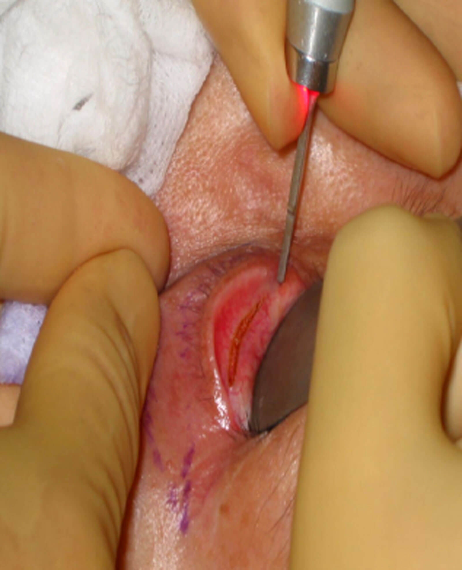 Photo showing lower eyelid bulging treatment.