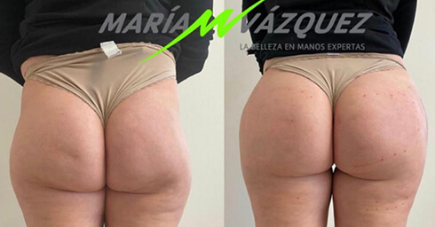 Before and after buttock augmentation