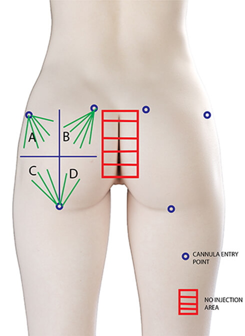 Buttock augmentation illustration of areas.