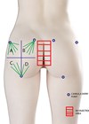 Buttock augmentation illustration of areas.