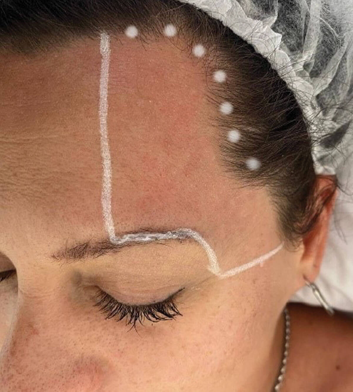 Treatment area marking photo.