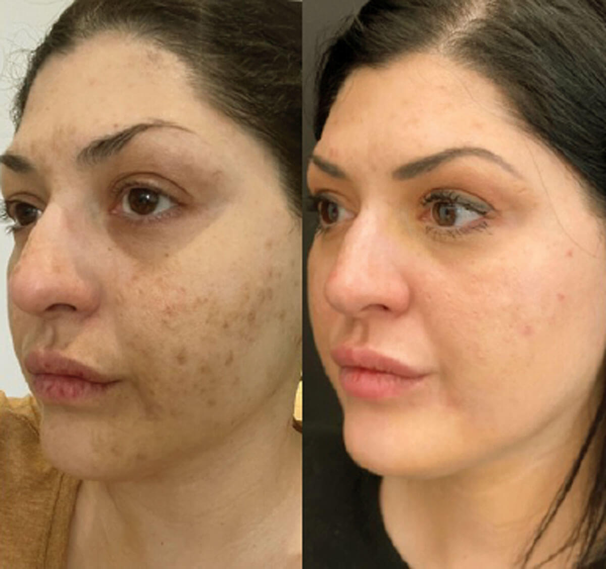 Photos showing before and three months after one treatment of Secret™ PRO.