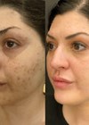 Photos showing before and three months after one treatment of Secret™ PRO.