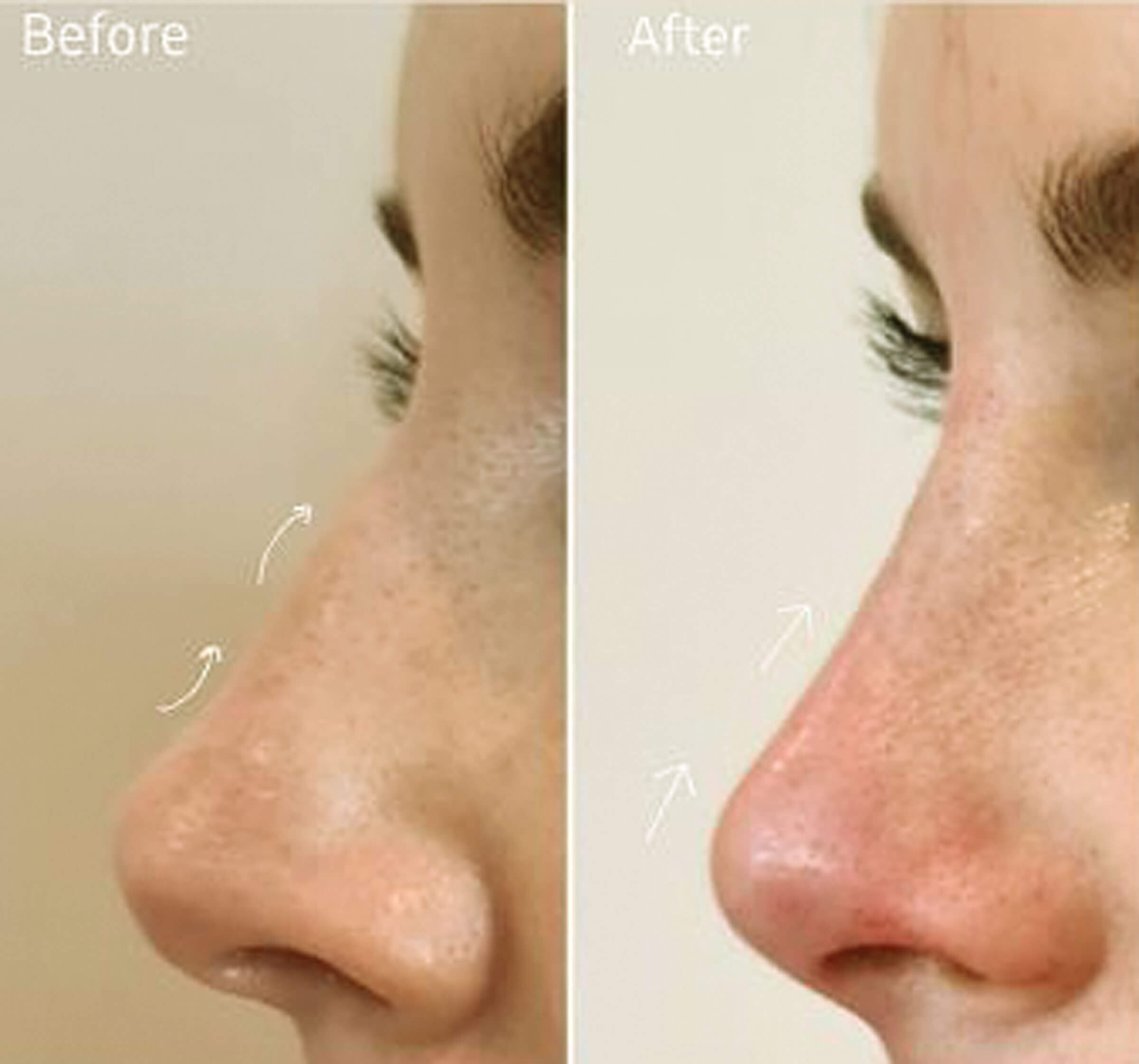 NSR with dermal fillers article before and after photos.