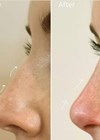NSR with dermal fillers article before and after photos.