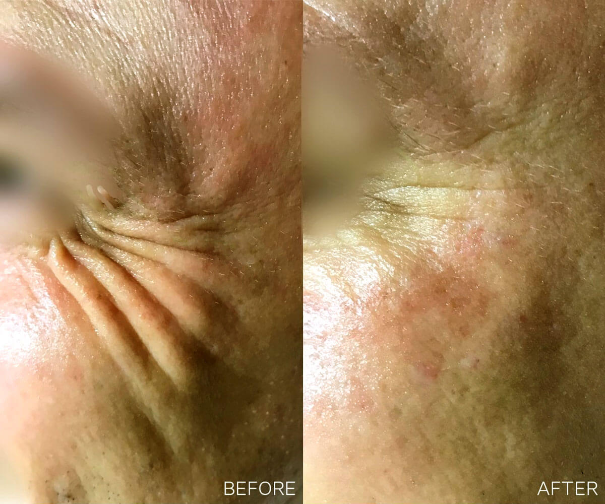 Photos showing before & immediately after treatment to the crow’s feet area with the VISCODERM Hydrobooster (IBSA) injected into the crow’s feet area.