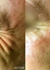 Photos showing before & immediately after treatment to the crow’s feet area with the VISCODERM Hydrobooster (IBSA) injected into the crow’s feet area.