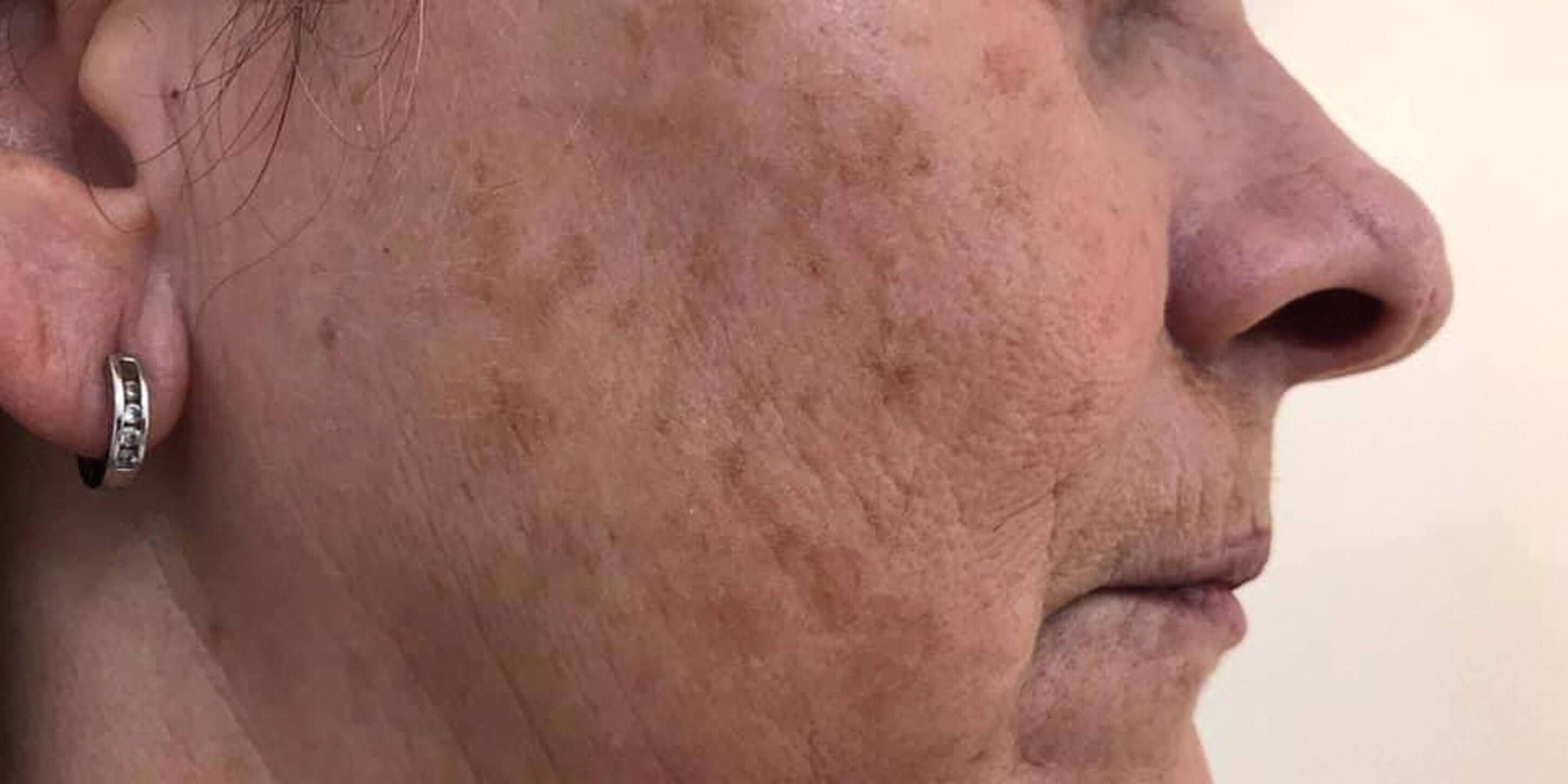 Capponi article photo - before treatment.