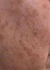 Capponi article photo - before treatment.