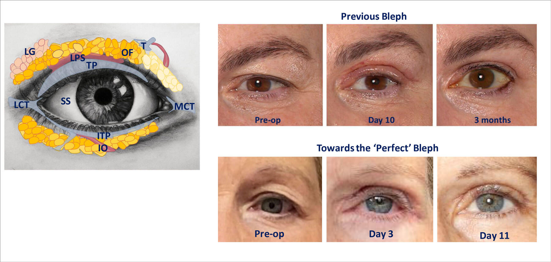 Clinical images showing the results of a standard FaceRestoration bleph. 