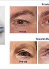 Clinical images showing the results of a standard FaceRestoration bleph.