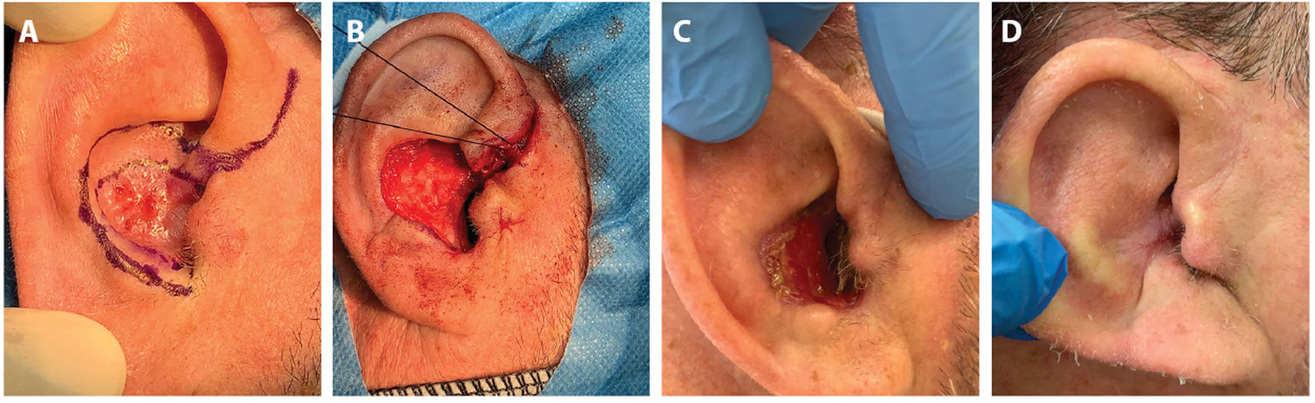 Photos showing external ear reconstruction. 