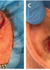 Photos showing external ear reconstruction. 