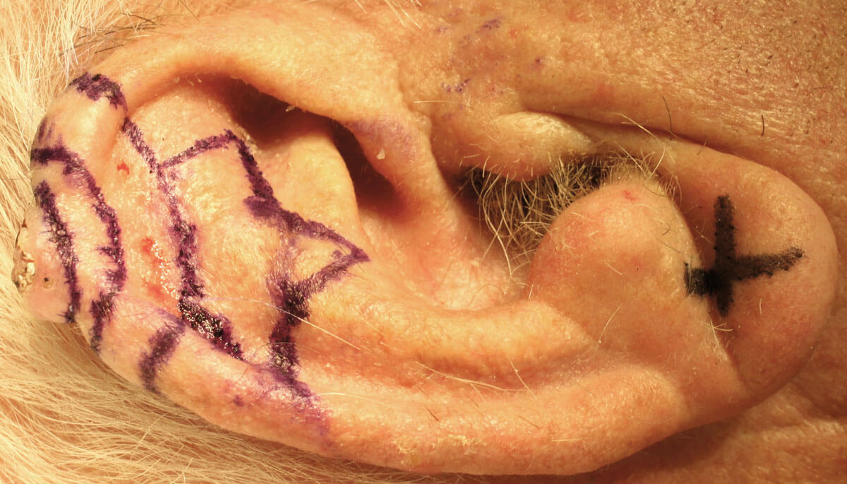 Photo showing auricular lesion with excision margin and three-limbed star-pattern design. 