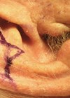 Photo showing auricular lesion with excision margin and three-limbed star-pattern design.
