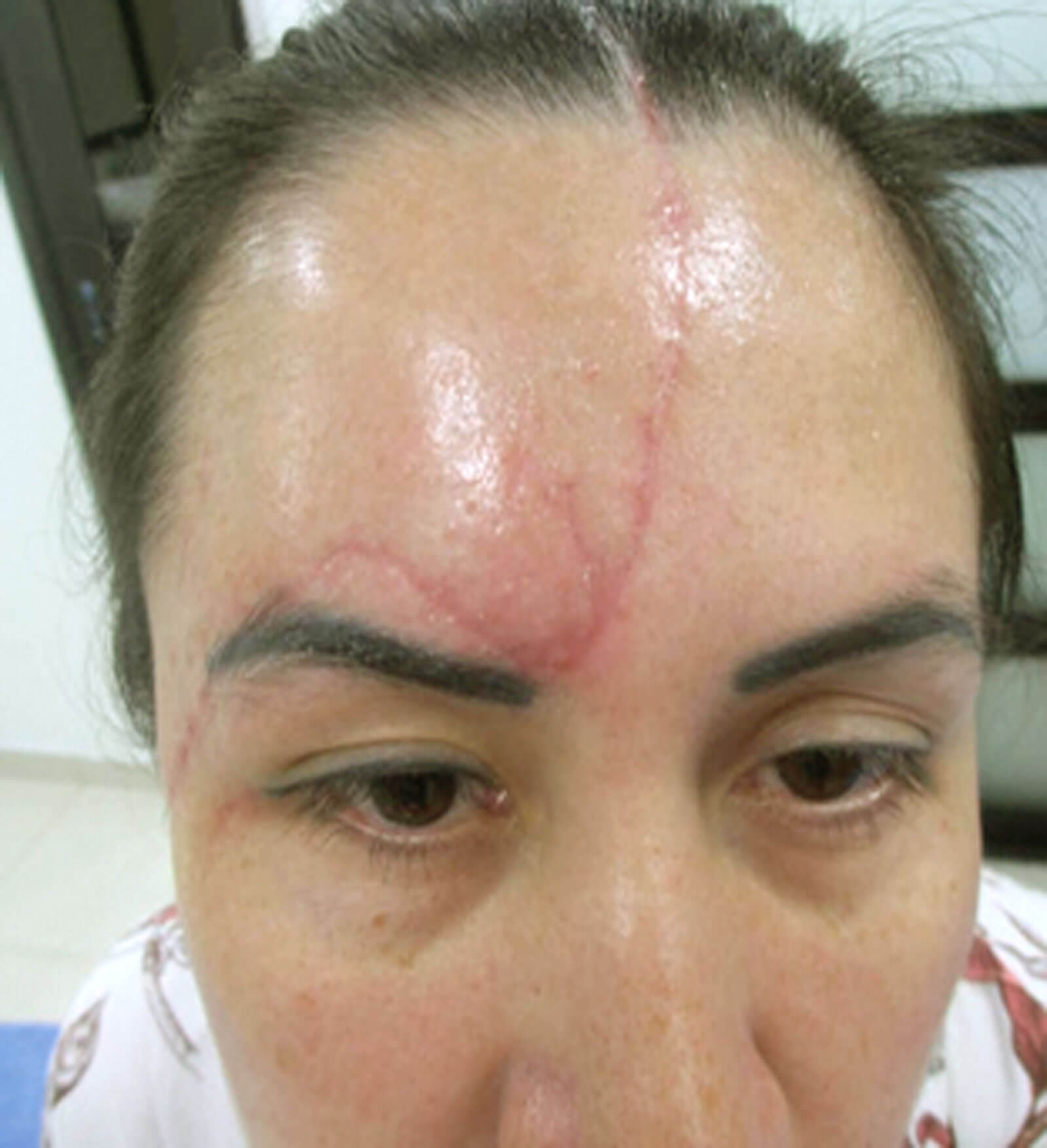 Laser therapy photo - before. 