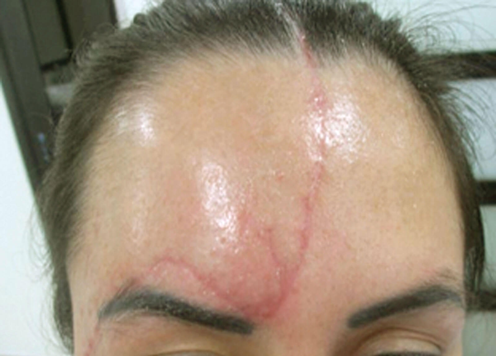 Early treatment of scars with laser therapy | The PMFA Journal