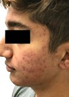 Photo showing skin type IV patientt before four Aerolase Neo Elite acne treatments. 