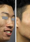 Before and after pictures of the patient treated with ablative fractional nanosecond Nd:YAG.  